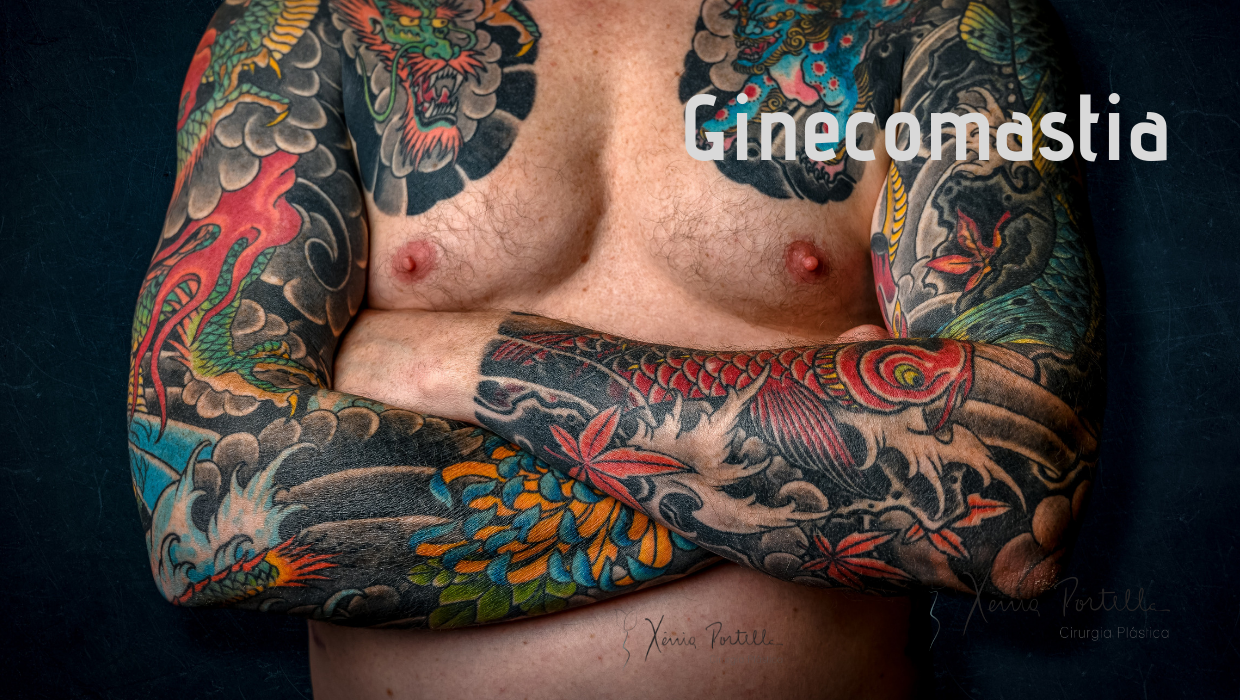 Ginecomastia